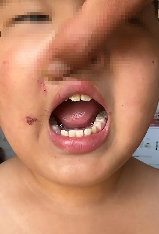 吃瓜磕掉二颗门牙视频,网友热议安全意识与意外防范